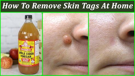 How To Remove Skin Tags at Home : 7 Best Skin Tag Removal Ideas - AimDelicious