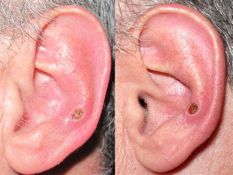 Skin Cancer On Ear Lobe