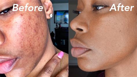 Can Taking Collagen Help Acne Scars at Leland Evans blog