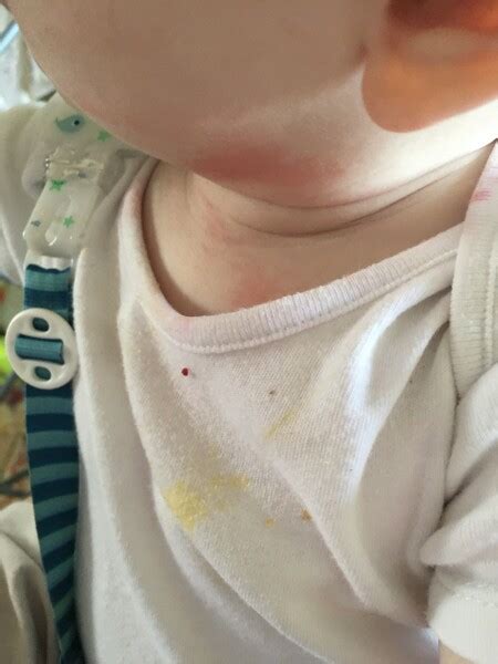 Is this tomato allergy? | Mumsnet