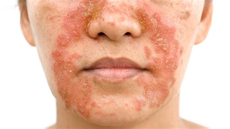 Skin Rash On One Side Of Face | Allergy Trigger