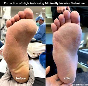 High arch is causing my foot problems. What is the solution? - CNOS