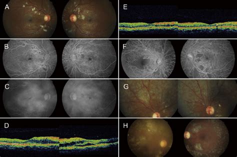 Diabetic retinopathy changes in Case 5 after pancreas transplantation... | Download Scientific ...