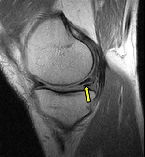 Torn Meniscus - Signs & Symptoms, Test, Diagnosis, Recovery, Treatment