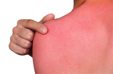 The secret to curing your sunburn is in your fridge | Daily Mail Online