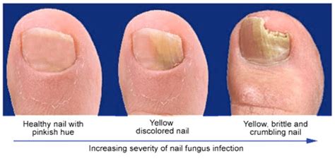 Aggregate more than 132 nail fungus after manicure - songngunhatanh.edu.vn