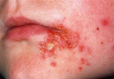 Impetigo skin infection - Stock Image - M180/0096 - Science Photo Library