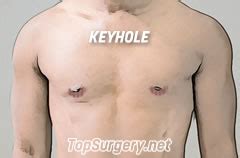 Top Surgery Scars - Best Ways To Treat Top Surgery Scars