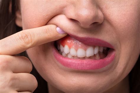 How To Reduce Swelling Of The Gums » Preferenceweather