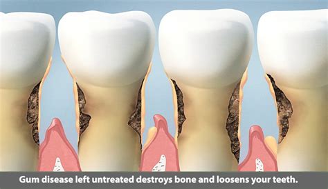 Horizontal Bone Loss – The Pasadena Dentist: Michael Nugent DDS