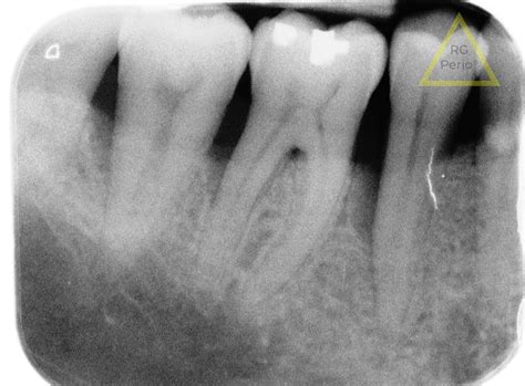 Bone Regeneration | Periodontal Bone Loss Treatment Results