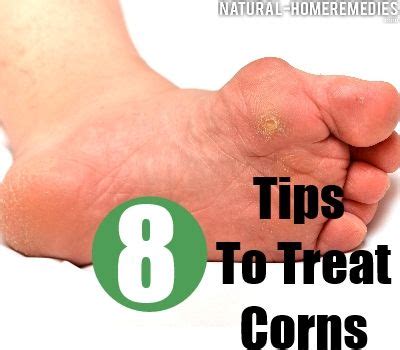 How To Avoid And Treat Corns The Herbal Natural Way | Corn treatment, Get rid of corns, Home ...