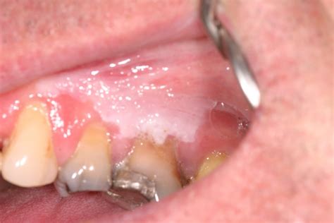 Leukoplakia, Hairy Leukoplakia - Causes, Diagnosis, Treatment