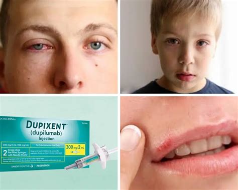 Dupixent Side Effects For Eczema