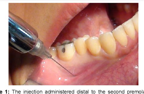 Figure 1 from Anesthetic Efficacy Assessment of Two Mental Nerve Block Techniques for Tooth ...