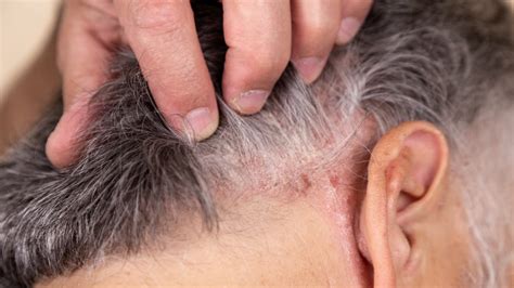 Psoriasis on your scalp