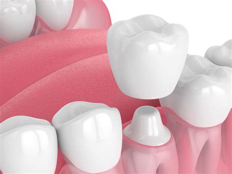 Different Types of Dental Crowns | Landmark Dental Arts