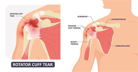 What is the rotator cuff of the shoulder? — Lake Washington Physical Therapy