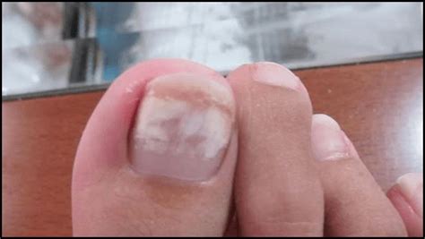 The Best What Are White Spots On Nail Beds Pictures - jonathansamplecomics
