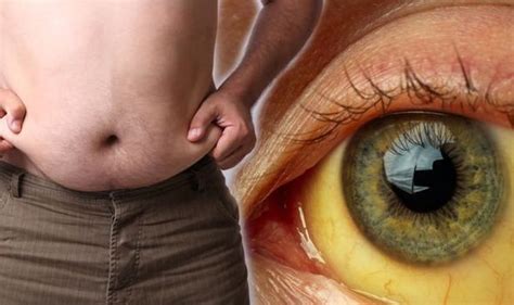 Fatty liver disease: Have you noticed your eyes are more yellow? Risk found in your eyes ...