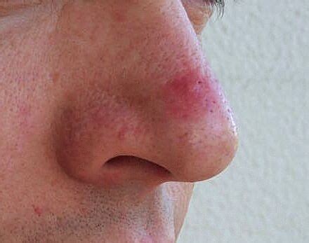 Rosacea Pictures: papules, pustules, red nose and acne : Rosacea ...