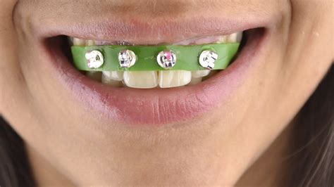 How To Make Diy Fake Braces / Braces Bracelets | Diy bracelets how to make, Bracelet ... : How ...