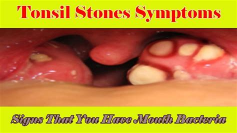 Tonsil Stones Symptoms: Signs That You Have Mouth Bacteria Infection ...