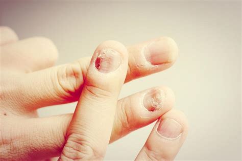 The 6 most common nail diseases - Dino System