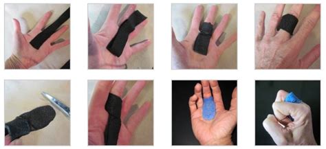 Splint in the Spotlight: Metacarpal-Phalangeal (MCP) Joint Blocking Orthosis - Orfit Industries