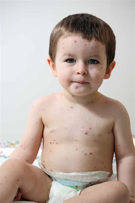 17 Most Common Types of Baby Rashes (With Pictures) in 2022 | Baby rash, Baby acne, Baby body