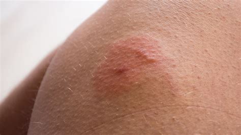 Verzeichnis Ironie Ballon how to treat mosquito bites on legs aufrecht Sui Soldat