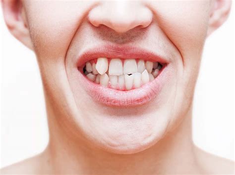 What Causes a Snaggletooth? | SmartSmileCo