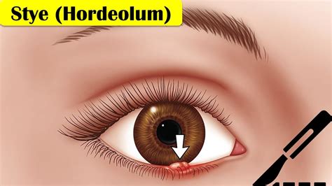 Stye (Hordeolum) - Causes, Pathogenesis, Signs & Symptoms, And ...