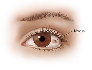 Understanding Nevus (Eye Freckle) | Saint Luke's Health System