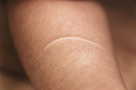 How Laser Treatments Can Help Fade Your Scars - CNET