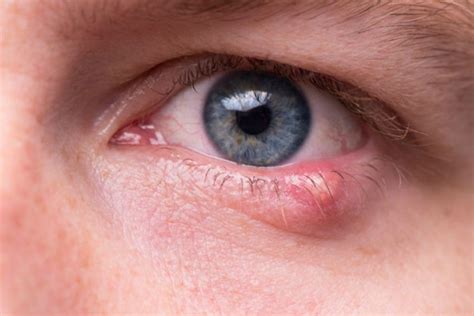 Causes of White Bumps Under The Eyes - Eye Conditions - The Eye News