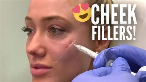 Cheek Fillers 🍎(Using Radiessse) - YouTube