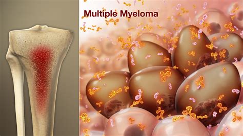 Multiple Myeloma