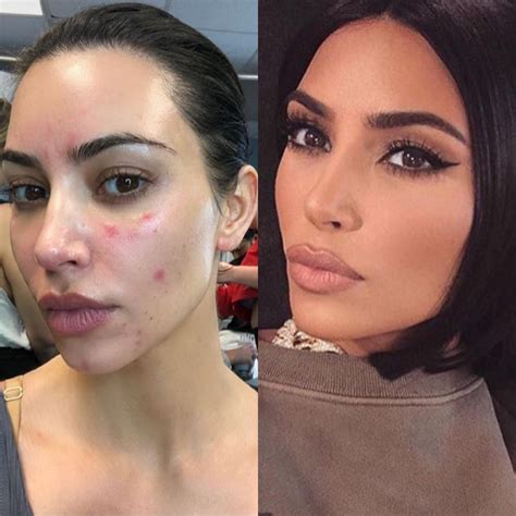 Kim Kardashian Skin Psoriasis