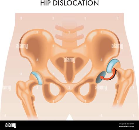 Dislocation of the hip Stock Vector Images - Alamy