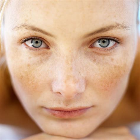 What is the Difference Between Freckles and Age Spots via @inviciblescars Skin Care Advices ...