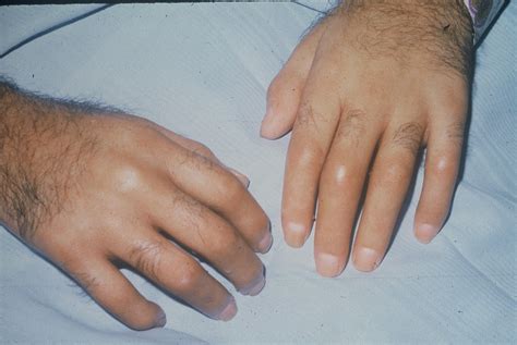 Sclerodactyly (Scleroderma) – RheumExam Atlas