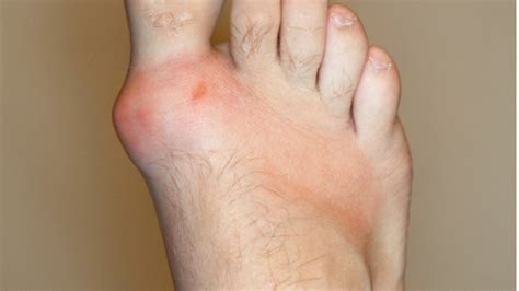 Can Gout Cause Ankle Swelling