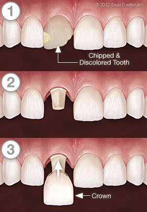 Crowns & Bridgework | Dr. Paul Rosenblitt | Cleveland OH