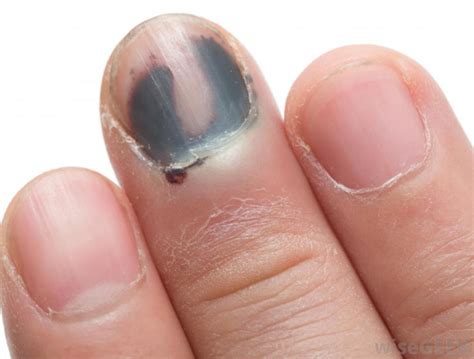 Do you know these nail disorders and abnormalities? – J. Soltman ...