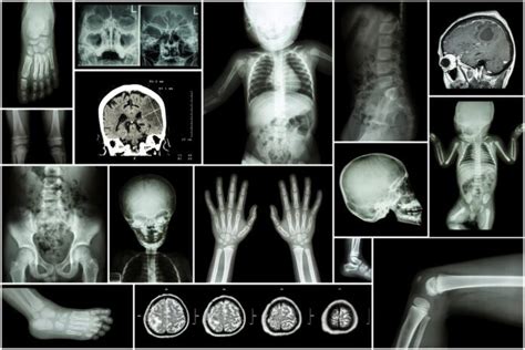 Brittle Bone Disease : Overview, Causes, Symptoms, Treatment - illness.com