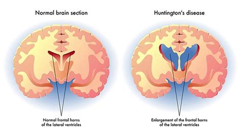 Chorea Huntington - Ursache & Symptome