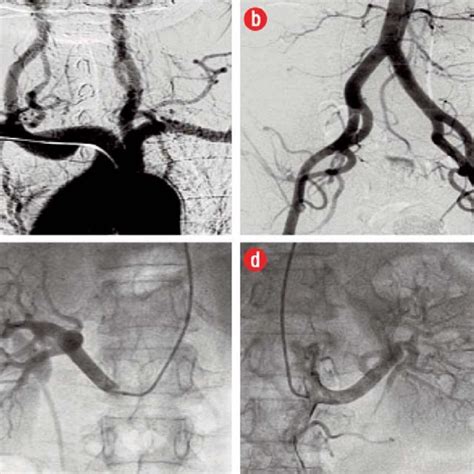 Angiogram of the left anterior descending (LAD) coronary artery in the... | Download Scientific ...