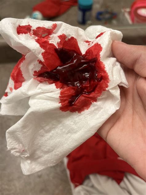 Is it normal for blood clots of this size to come out of my nose? : r/medical_advice