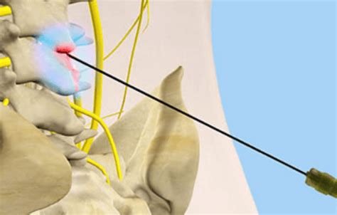 Chemical Lumbar Sympathectomy | PainMedSA